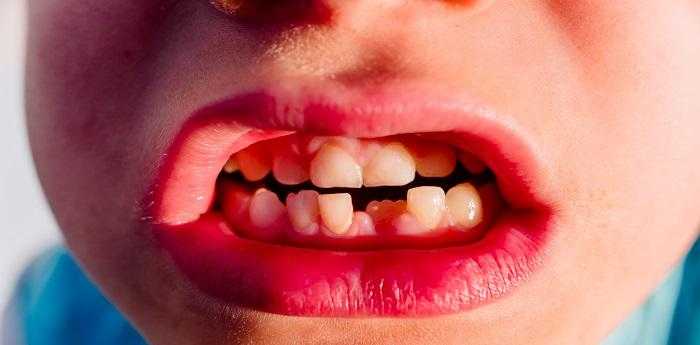 周公解梦梦见牙齿掉了是什么征兆